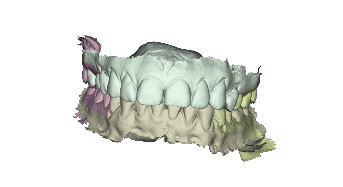 Advanced visualization of 3D dental models for dental planning and analysis with ActualPACS 3D dental model (STL format) of the patient's teeth